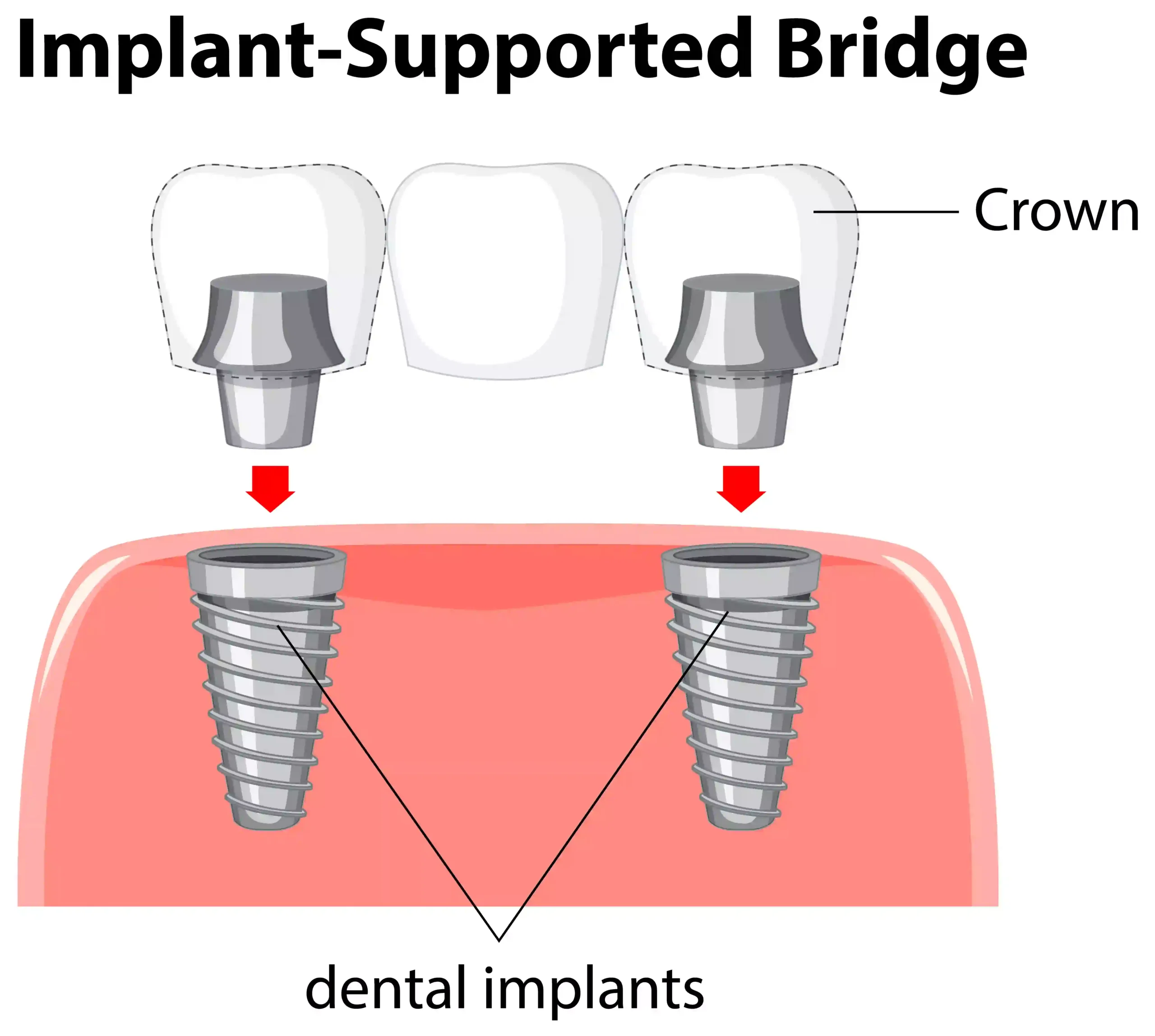 dental bridges vs implants