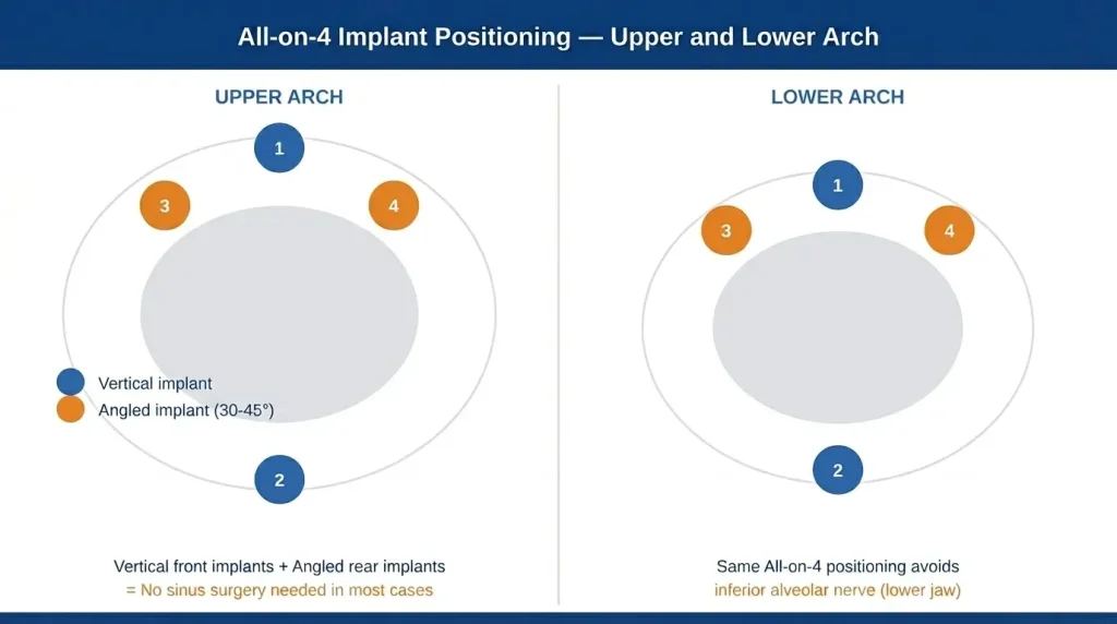 All-on-4 implant positioning